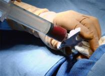 Premiera mondiala: Transplant reusit al unui vas sanguin realizat din celule susa